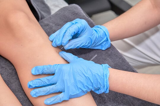 dry needling cheshire