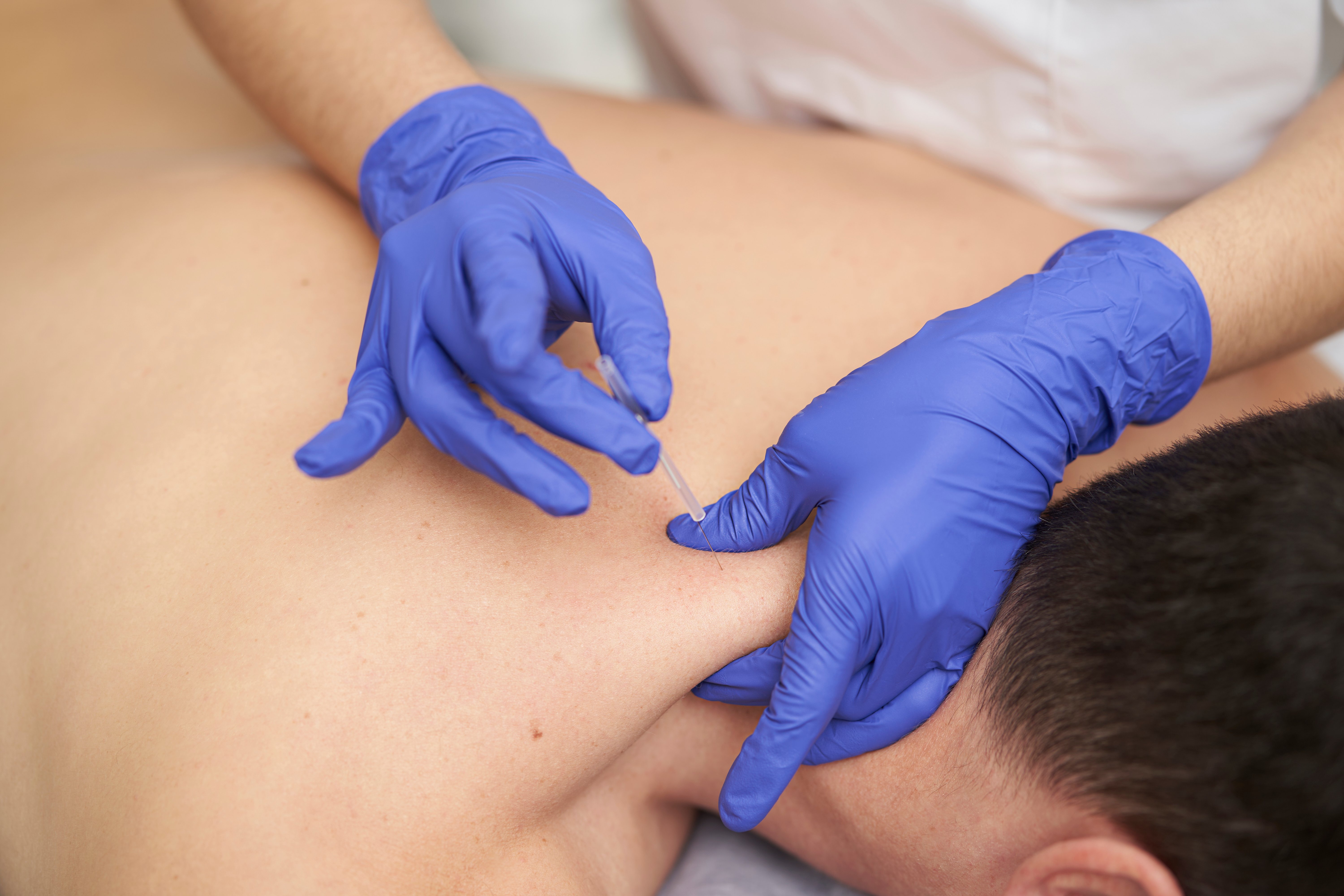 dry needling