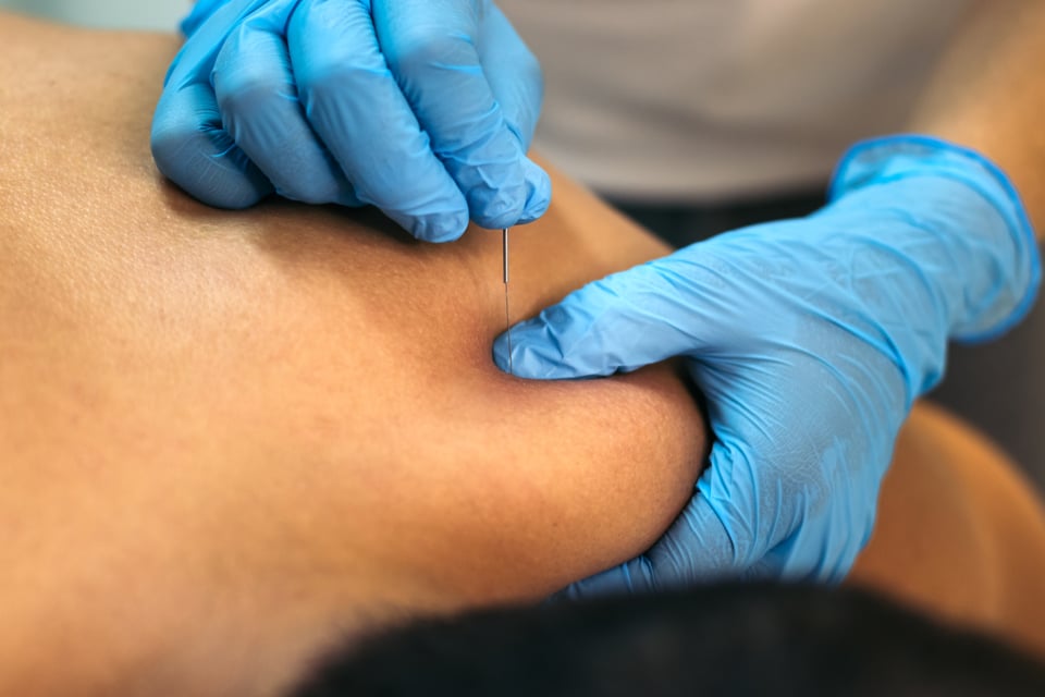 Dry Needling Physical Therapy