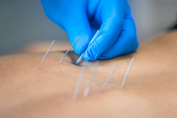 dry needling physical therapy