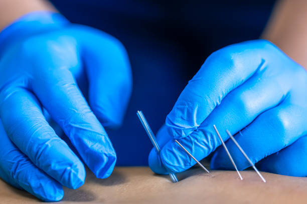 dry needling cheshire